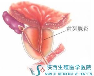 慢性前列腺炎的檢查項目