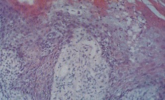 尖銳濕疣的發(fā)病原因